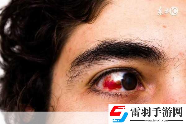 眼睛也會中風(fēng)。