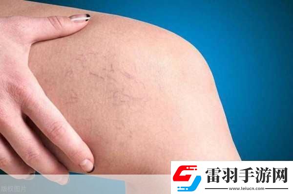 日系裸妝女士靜脈曲張是什么得的