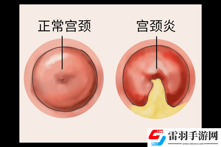 啪啪頂?shù)阶罾锩媪餮闆r是否常見(jiàn)及相關(guān)探討
